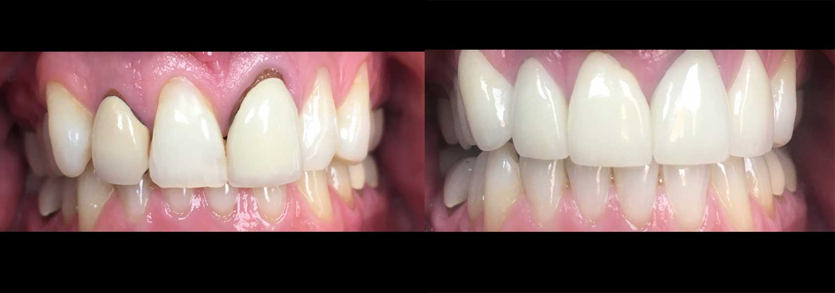 Before & after a dental crown by Grand Dentistry