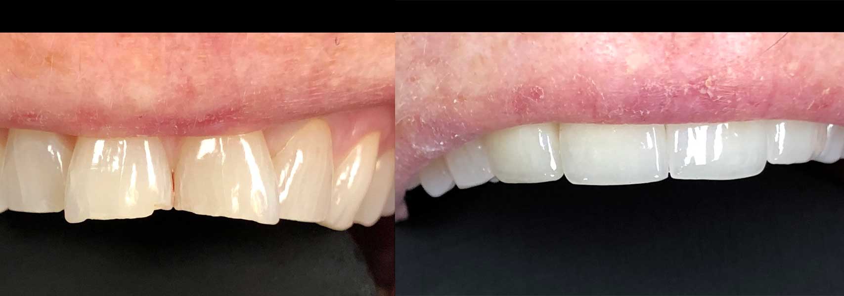 Before & after dental veneers