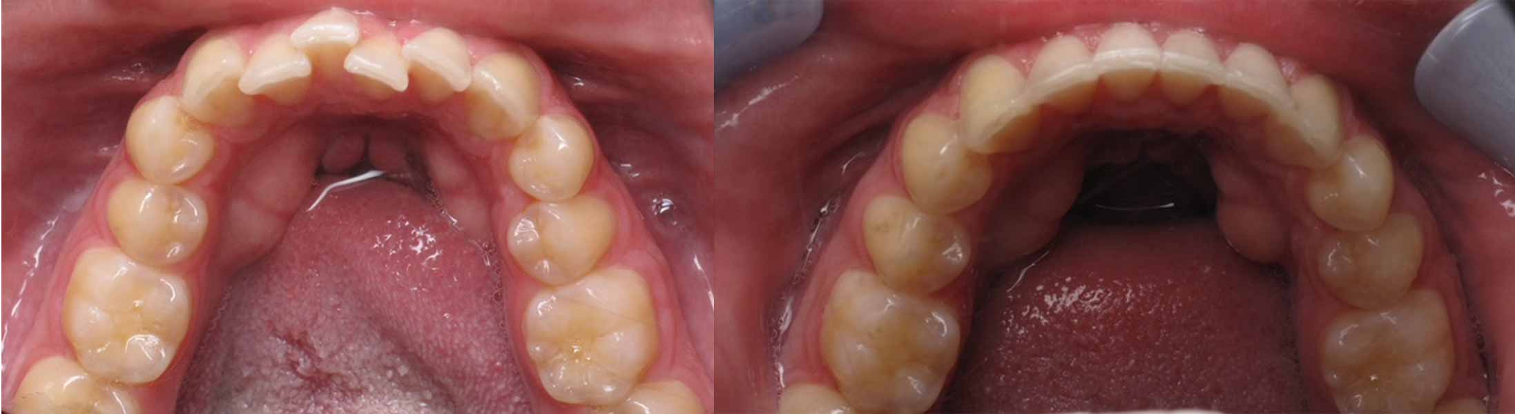 Before & after Invisalign treatment by Grand Dentistry
