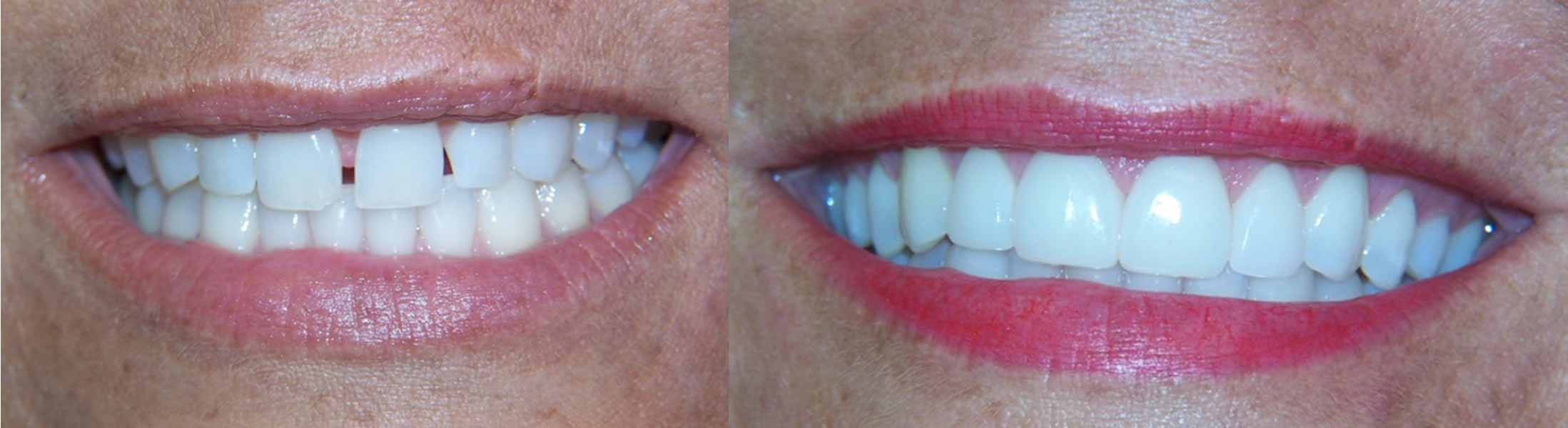 Female patient with new dental veneers