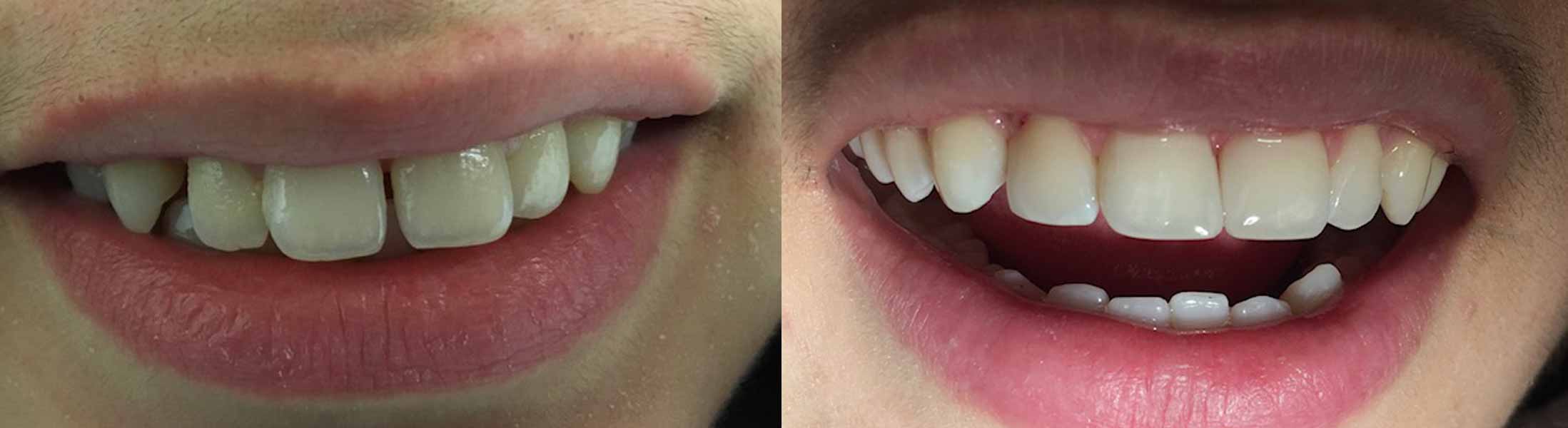 Patient with new dental veneers from Grand Dentistry