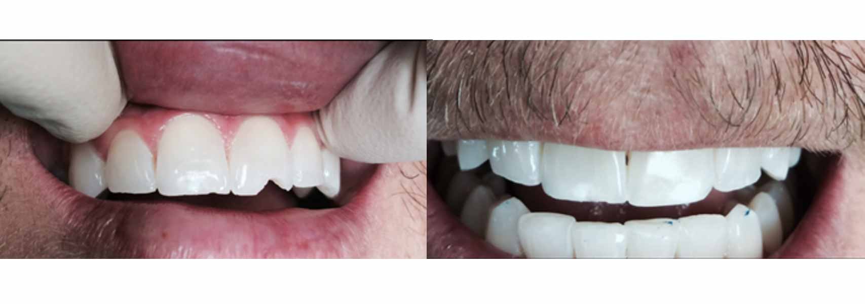 Before and after pictures of general dentistry services at Grand Dentistry in Escondido, CA